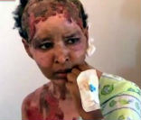 Image of Shweyga Mullah recounts to reporters how she was cruelly burned by Aline Gaddafi. 