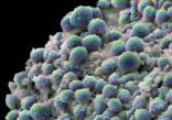 Image of Prostate cancer cells. The quiz will give men a better idea of what to expect after they beat cancer.