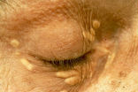 Image of Xanthelasmata is an indicator of a deadly condition.