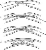 Image of This diagram shows how the Gateway-Wingspan stent is intended to work.