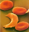 Image of A misshapen sickle cell as imaged under a microscope.