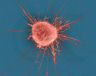 Image of Beta blockers may stop the spread of breast cancer cells.