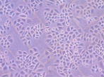 Image of Human cells in a petri dish. If this can be done so easily, why hasn't it been done sooner for cancer? Pictured: two intestinal cancer cells.
