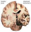 Image of A healthy brain section (left) next to a section that has been ravaged by Alzheimer's disease (right).
