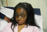 Image of Losing her eyelids, eyebrows and being disfigured by acid thrown on her by Mary Konye, Noami Oni is looking for love after two years of reconstructive surgery.