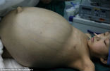 Image of 11-year-old Han Bingbing underwent eight hours of surgery to remove a 33 pound tumor from her abdomen.