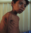 Image of Tuberculosis, also known as the 