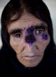 Image of Leishmaniasis, the 