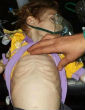 Image of Starving Syrians die each day due to the effects of the civil war and lack of humanitarian aid (Facebook).