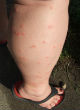 Image of Too many Americans believe Zika is passed like a cold (Steele Roddick).