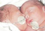 Image of Doctors believed the twins wouldn't survive (PA).
