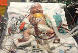 Image of Nathan Byrne's heart stopped and doctors ran out of room to add tubes (Michael Traill).