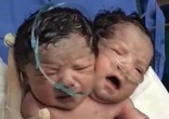Image of The conjoined twins have their own brains and head but share a single body (CEN).