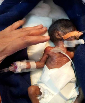 The newborn boy measured at the length of an adult palm. [Photo by: Cover Asia Press]
