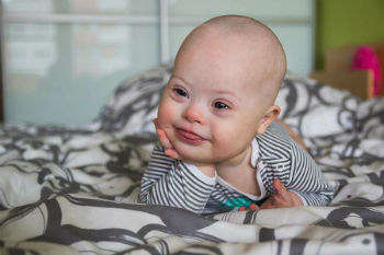 Baby with Down Syndrome