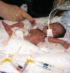 Image of PREMATURE - Mairead Catherine Molloy was born more than three months early, weighing less than 2 pounds. She spent much of the first months of her life hooked up to machines to feed her and help her breathe. 