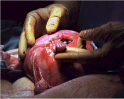 Image of Samuel Armas still has strong hands. Here he is pictured during his first surgery which took place in the womb. Today, nine years later, he is fond of white water rafting.He is also happy to have become a symbol of the truth about the Right to Life. 