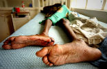 Image of MDR-TB is a major killer and when it combines with diseases such as HIV, there is no chance of survival. 