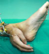 Image of A Chinese man had to have his hand attached to his ankle after severing it off his arm.
