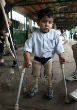 Image of A young boy struck by a sitting mine.