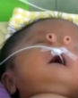 Image of Baby Angelito was born with two tubes for a nose.